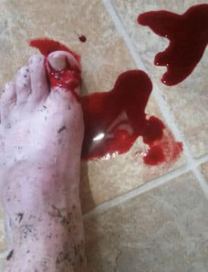 Bloody Big Toe Injury from Pressure Washing