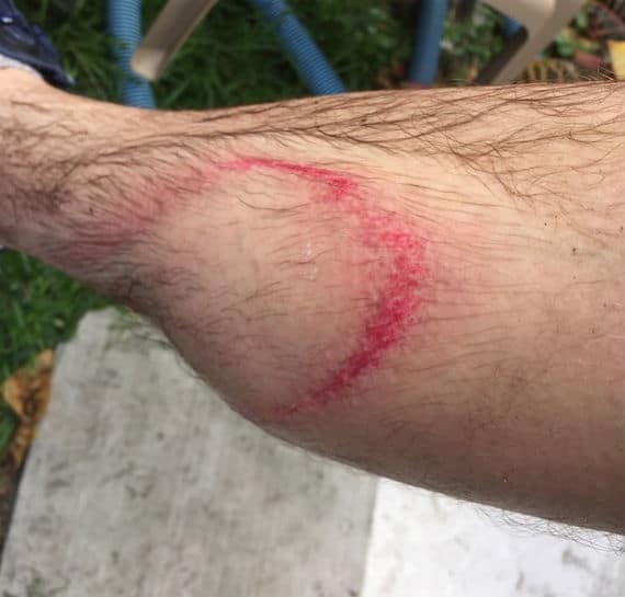 Pressure Washing Injury To Skin Laceration